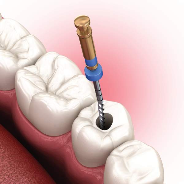 Endodontics Castle Rock CO Endodontist Near Me Gentle Root Canals