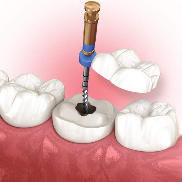 Endodontics Castle Rock CO Endodontist Near Me Gentle Root Canals